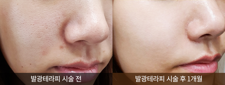 전후사진