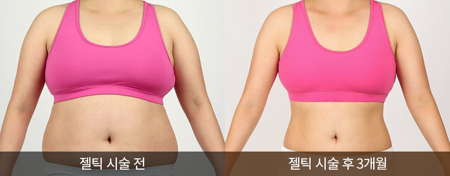 전후사진