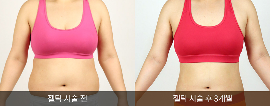 전후사진