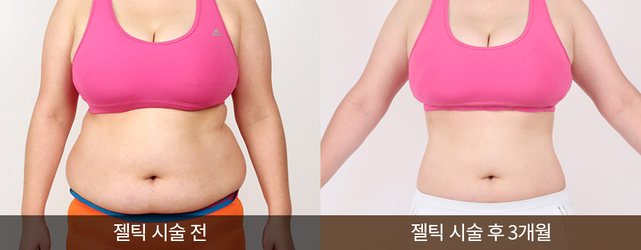 전후사진