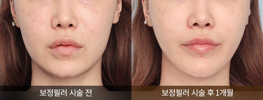 전후사진
