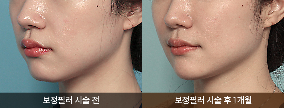 전후사진