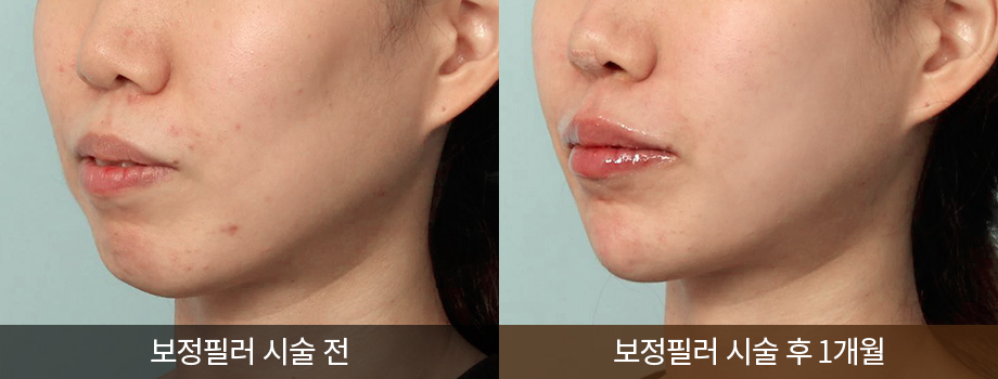 전후사진